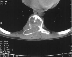 туморната маса с евентуална едноетапна или на втори етап спинална стабилизация. Впечатленията от радиотерапията са маргинални, но повечето автори ги препоръчват при резидуални или рецидивни процеси.