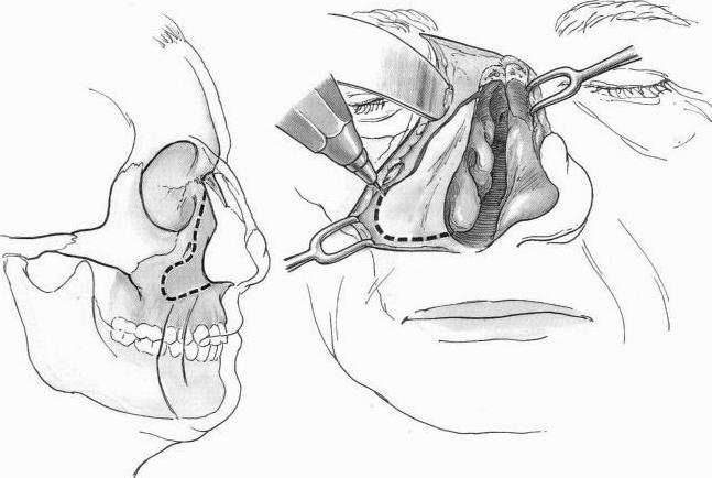 Фиг. 4. Медиална максилотомия с последваща реконструкция. (От Donald PJ: Surgery of the skull base, Chapter 10, Lippincott-Raven, Philadelphia-New York, p. 171, p.