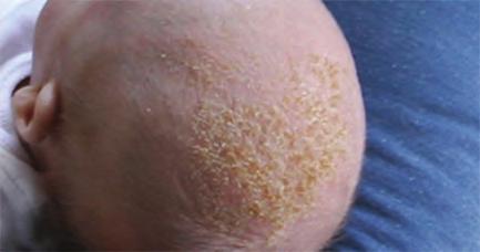 жлези (себум) и опортюнистична инфекция с Malassezia (Pityrosporum), фиг. 4. Себорейният дерматит има благоприятен ход и обикновено не налага активно медикаментозно лечение.