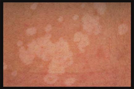 ТЕМА НА БРОЯ Фиг. 10. Pityriasis versicolor Склеродермия Системно съединително-тъканно заболяване, характеризиращо се с прогресивна индурация на кожата, симптом е на системната склероза.