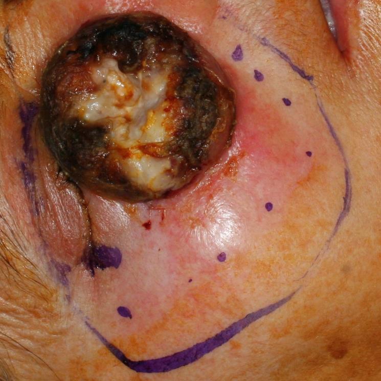 Плоскоклетъчен карцином на кожата на клепача и бузата. Пунктирът с точки показва ориентировъчно края на туморната инфилтрация.