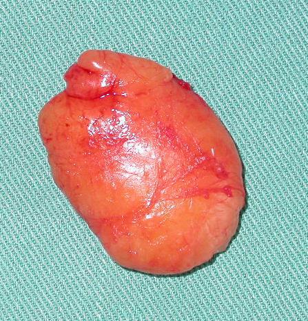 Доброкачествен тумор липом Туморът изглежда капсулиран с тънка