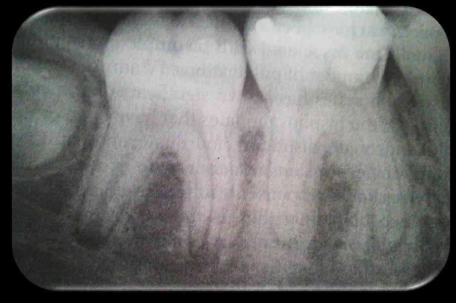 Фокален склерозиращ остеомиелит RADIOLOGY Локализирана с повишена плътност лезия свързана със зъб.