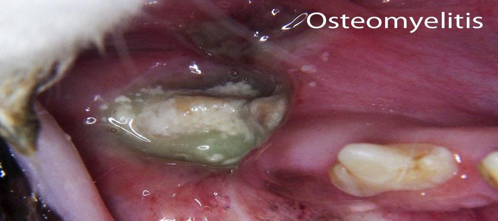 Osteomyelitis Инфекциозен гнойно- некротичен процес, - обхващащ всички части на костта- периост, компакта, спонгиоза, костен мозък - под въздействие на агресивни фактори с