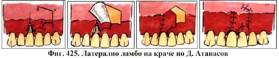 Метод на Атанасов покриване с ламбо по съседство съставено от мукопериостална и лигавична част. 1.