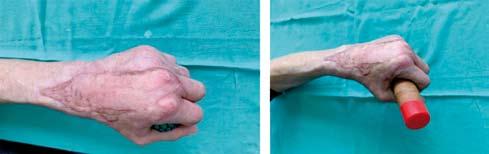 При нито един от пациентите не се наблюдава разлика в релефа на оперираната зона и интактната кожа.
