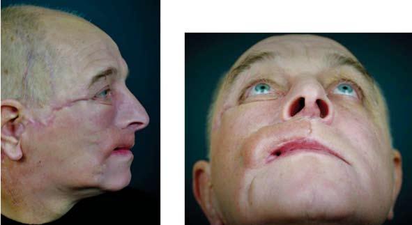 след края на комбинираното хирургично/лт лечение Обсъждане Морфейните базоцелуларни карциноми на лицето често представляват предизвикателство по отношение на разпространението си и ангажирането на