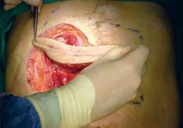 При двама пациенти (5,9%) с долна параплегия и декубитални рани в тазовата област се получи частична дехисценция на ламбата, което наложи допълнителна хирургия за преодоляване на усложнението.