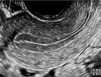 при което маточната лигавица се сканира последователно от цервикалния канал до фундуса на матката в