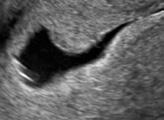 ACOG Committee Opinion No. 426: the role of transvaginal ultrasonography in the evaluation of postmenopausal bleeding. Obstet Gynecol 2009;113:462-464. 4. Dijkhuizen F, Brolman H, Potters A, Bongers M, Heinz A.