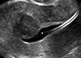 Can the endometrial thickness as measured by transvaginal sonography be used to exclude polyps or hyperplasia in pre-menopausal patients with проучвания, тъй като всеки колектив използва различни