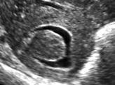 Ultrasound Obstet Gynecol 2002;20:370-376. 7. Epstein E, Valentin L.
