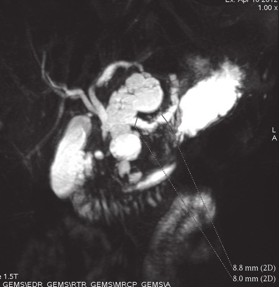 Магнитнорезонансна холангиопанкреатография (МРХПГ) в диагностиката на хроничен панкреатит Фиг. 3. Неравномерна дилатация на панкреасния канал и на периферните му разклонения Фиг. 4.