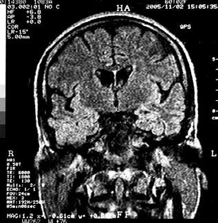 Г. Гозманов и др. Фокална епилепсия лекувана с ртмс били прилагани с 9 сm кръгла бобина, поставена върху вертекс, с честота 0,3 Нz.