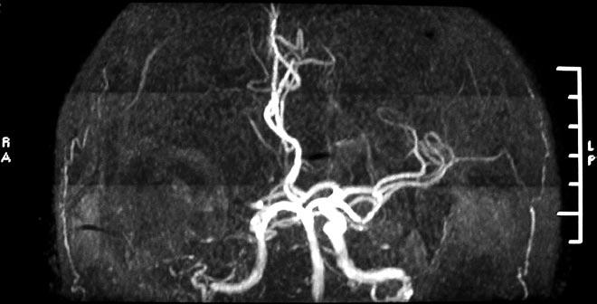 K. Prinova et al. Patient with Thrombosis of Middle Cerebral Artery in the Young Фиг. 3 Й.Г., м., 43 г. Магнитно резонансна ангиография. МРТ белези за тромбоза на М 1 сегмент на дясна СМА.
