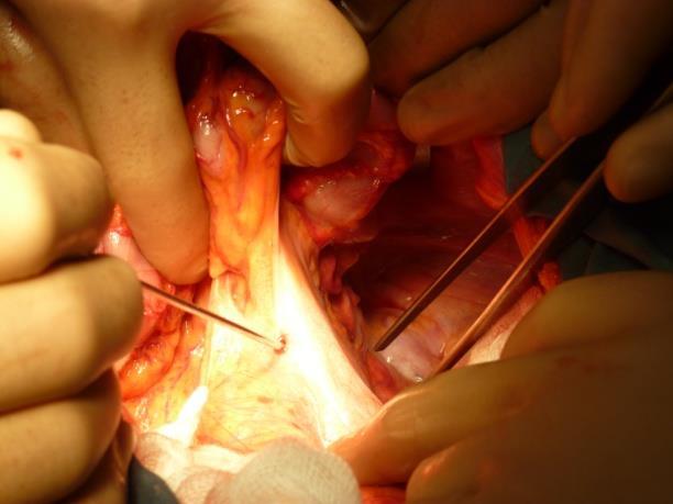 3.2. Пневмодисекция при конвенционалната и лапароскопската хирургия на правото черво Съществуването на хирургичния план може да се открие чрез определяне на подвижността между дадена висцерална