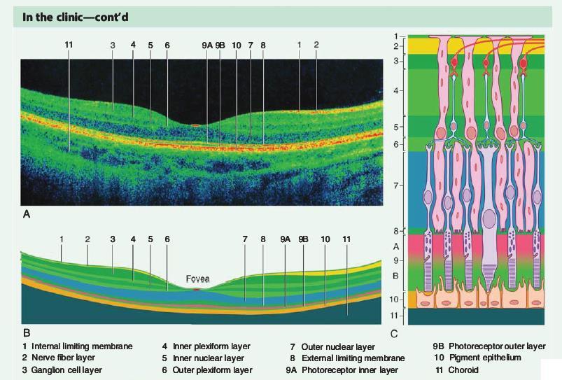 Highdefinition optical coherence tomography (HD-OCT) In vivo Метод, подобен на УЗ,