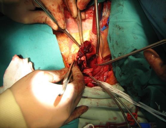 Фигура 15: Аортотомия визуализира се тромбозиралия фалшив лумен Оценката и хирургичната корекция на аортната клапа се извършва в този момент, докато системното охлаждане на пациента продължава.