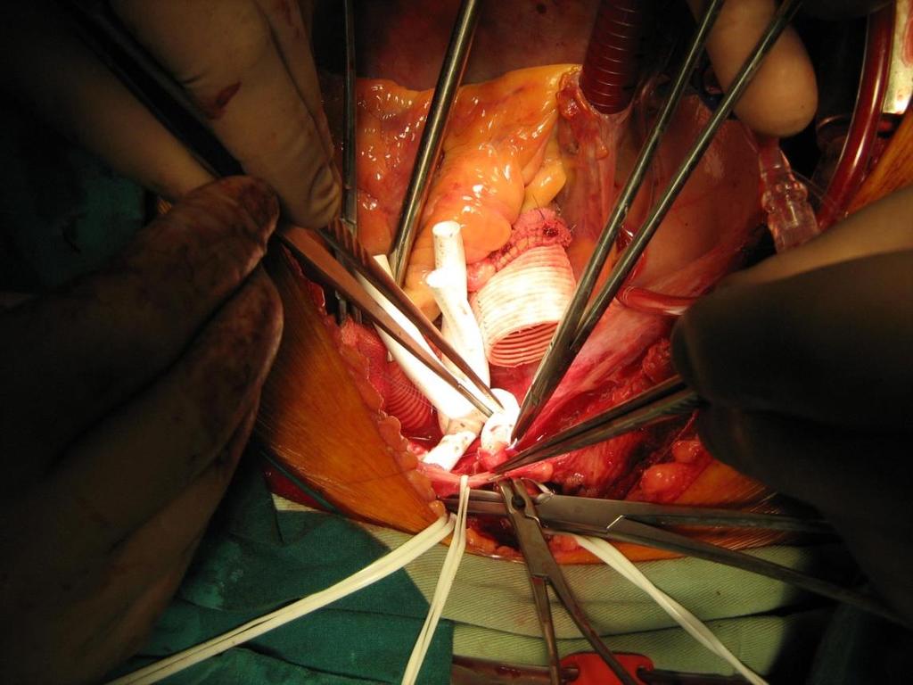 Фигура 16: Реимплантация на супрааркусните съдове чрез отделни протези Опративна техника при тип В дисекация Дясното странично декубитално положение е оптимално за осъществяване на хирургична