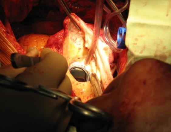 Фигура 21: Хронична аортна дисекация при 70-годишен пациент след аортно клапно протезиране Фалшиви аневризми на аортата (псевдоаневризми) Аортната псевдоаневризма (фалшива аневризма) се дефинира като