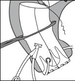 Фигура 25: Клапно-съхраняваща операция на David Мониторинг и анестезия Стандартно се канюлира радиалната артерия за инвазивно мониторинг на кръвното налягане и определяне активираното време на