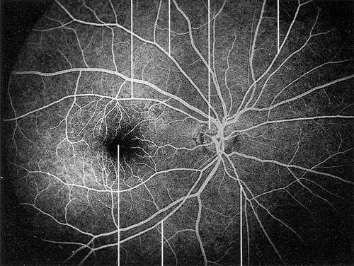 optici macula lutea c fovea centralis