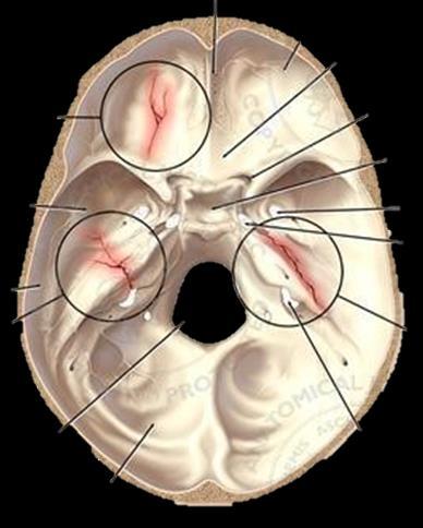 Прекъсване на обонятелните пътища при: Фрактури на fossa cranii anterior, засягащи lamina
