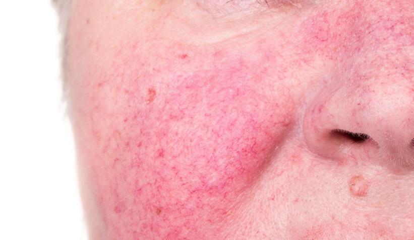 Риск от възпаление и алергии на кожата Розацея Розацеята е хронично кожно заболяване, което се характеризира с периодично повтарящи се епизоди на възпаление, зачервяване и акнеподобни обриви по