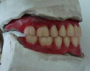 Нареждане на долен кучешки зъб Дисталният туберкулен ръб на 33,43 контактува с медиалния на 13,23.