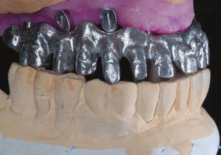 метална структура с акрилни зъби от