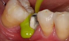 134 C SAFE A U TO C L AV E клиничен случай се разтича директно върху зъба и сулкуса Перфектни отпечатъци без кухини Поставена коронка