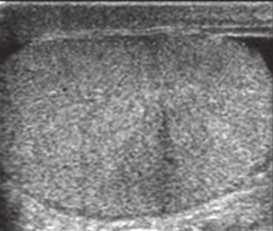 Остър скротум в детската възраст и ролята на Доплер сонографията в диференциалната диагноза В първите 1-3 часа не се наблюдават сигнификантни промени в сонографския образ на тестиса.