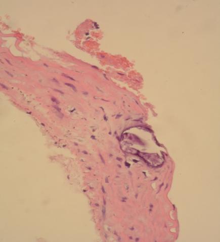Репрезентативна фотомикрограма на аортна стена (тънка стрелка ендотел; дебела