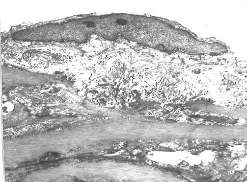 Репрезантативна фотомикрограма на електронно-микроскопско изследване на аортна стена на SHR. Участък от интима. Изразен оток и изтласкване на ендотела от разраснали колагенови снопчета черни стрелки.
