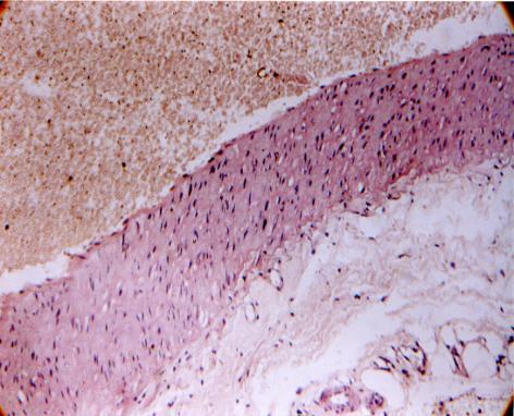 Хиперплазия на гладкомускулни клетки. Част от тях са в процес на напреднало стареене с тъмни пикнотични ядра и балониране на плазмените органели митохондрии.