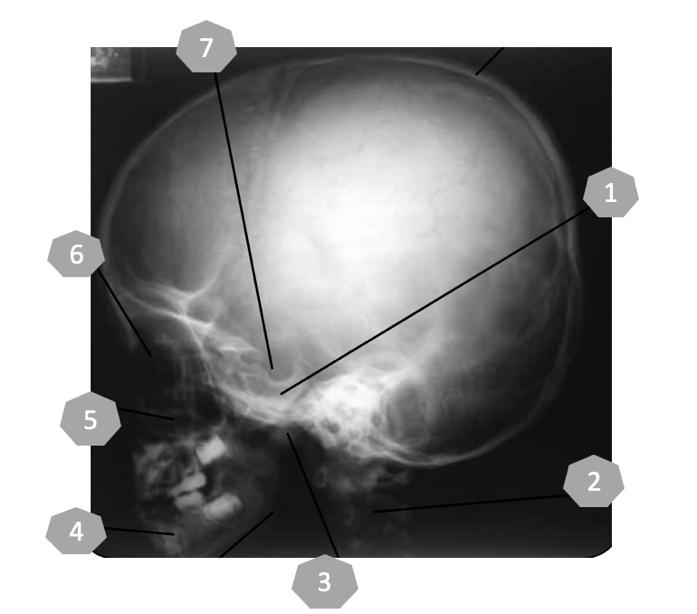 Профилна рентгенография на черепа Профилната рентгенография на черепа може да се използва при: Фрактури на лицевия и мозъчния череп Промени в sella turcica Този центраж се изпълнява като сагиталната
