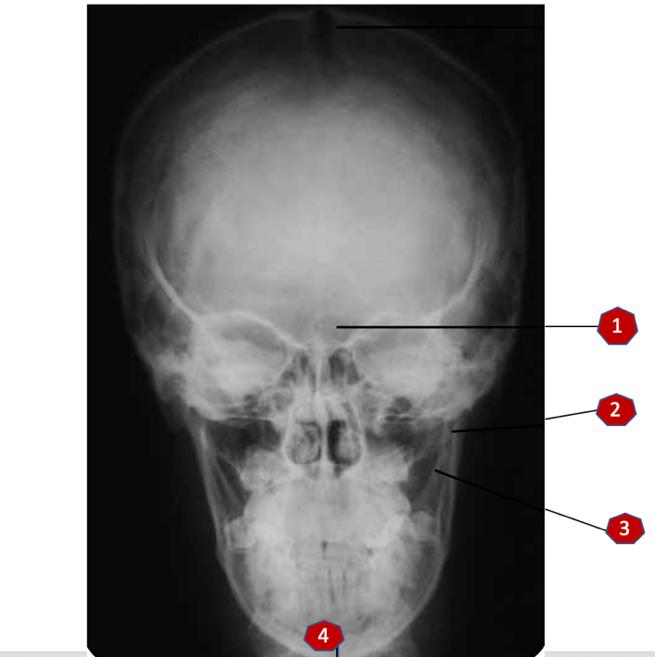 Fig. 10 Рентгенова антомия: 1. Sinus frontalis; 2. Proc. Condylaris; 3. Proc. Coronoideus; 4.