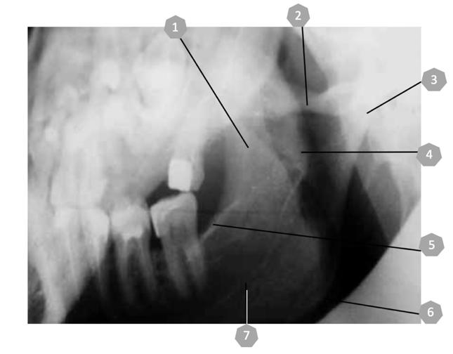 На Fig.12 е показана рентгеновата анатомия при екстраорална рентгенография, в случая на лява мандибуларна половина. Fig. 12 : 1. Proc.