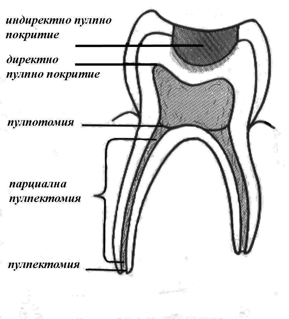 Методите на лечение на пулпана на временните зъби: Биологични методи идиректно пулпно