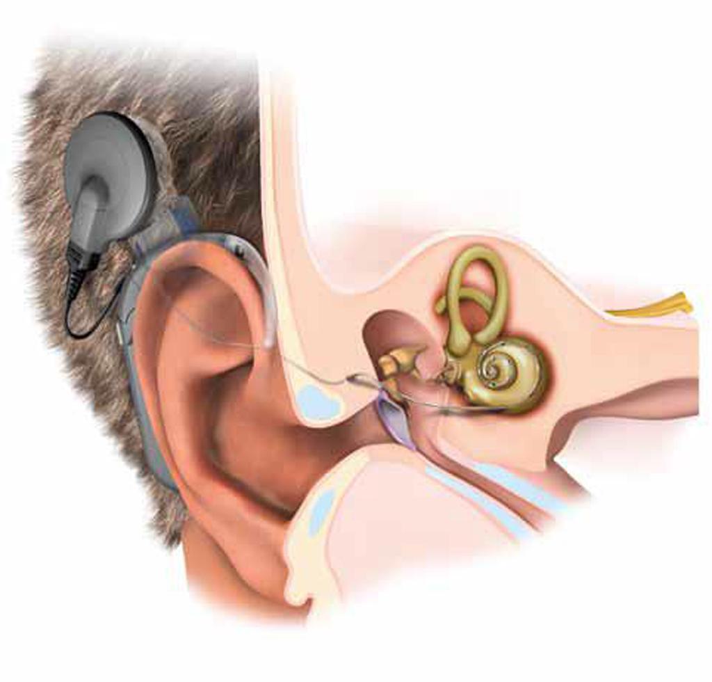 За успешното му протичане рехабилитаторът трябва да е запознат с фазите на изграждане на адекватни слухови представи за елементите на речта при слабочуващите, както и етапите през които преминава