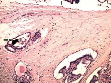 International Bulletin of Otorhinolaryngology 2 / 2016 Фиг. 1 Figure 1. The epithelium lining the cyst at higher magnification ( ).
