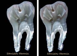 тип цяла зъбна дъга, изработена от полихроматичен Prettau 2 Dispersive цирконий върху