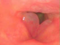 Това изследване предвижда оглед на структурата на гърлото, включително и в задната част на носа, задната част на устата, ларинкса и хипофаринкса.
