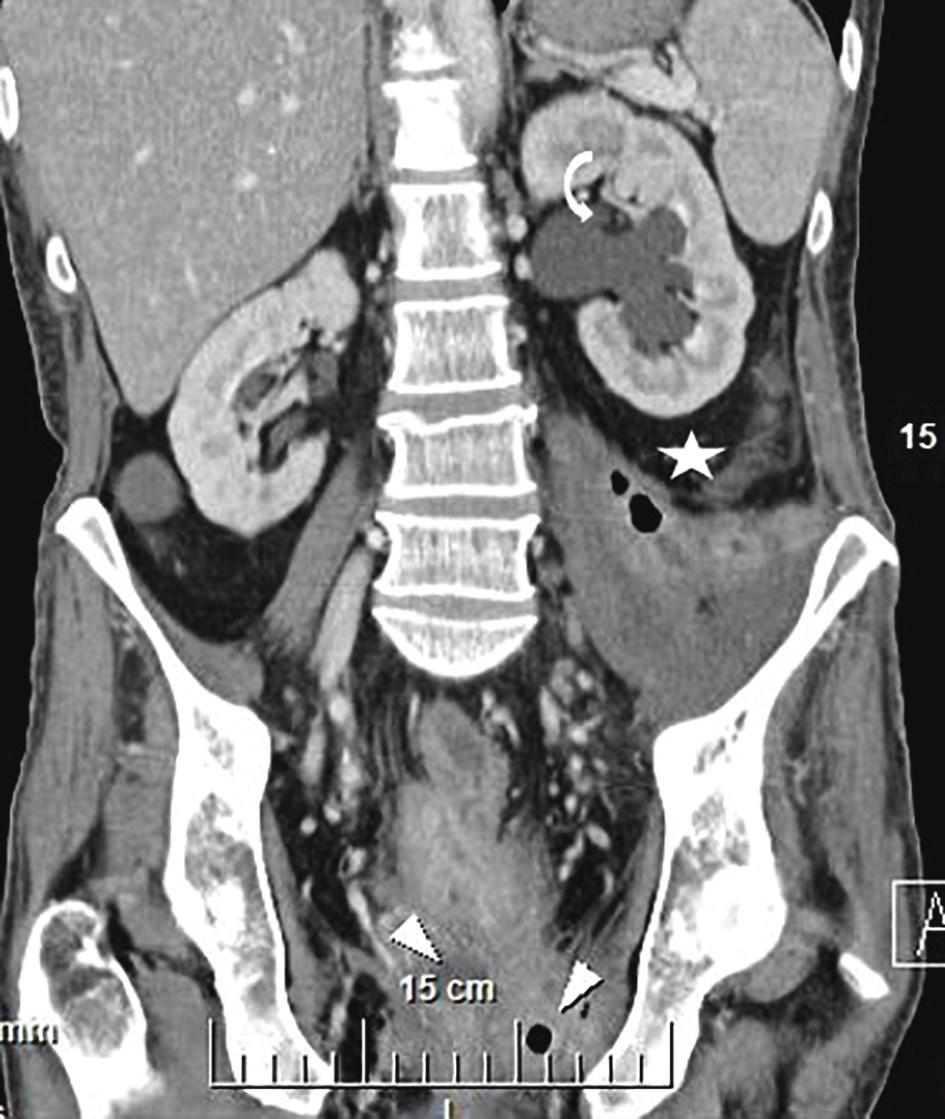 Фиг. 1. Постконтрастна КТ, коронарен срез на пациент с абсцес в ляв илиопсоасен мускул (звезда) и перианално (бяла стрелка).