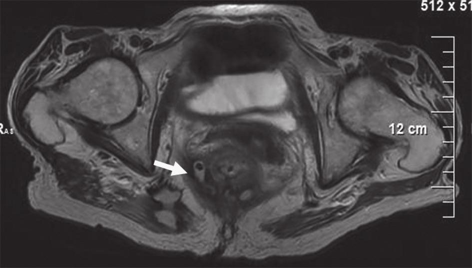 Абсцеси при пациенти с болест на Крон гледната точка на рентгенолога Фиг. 3. Постконтрастна КТ, коронарен срез (фиг. 3а) и аксиларен срез (фиг. 3б).
