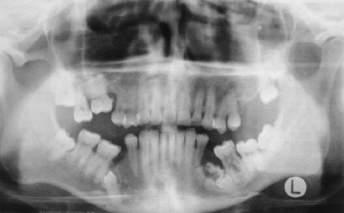 Dentalniot status na }erkata vo gornata vilica otkri potonati primarni vtori molari na dvete strani i nad