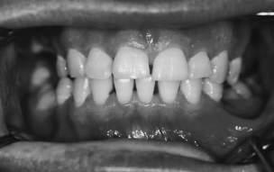 Vo mandibularniot dentalen lak ima im pakcija na istite zabi na levata strana, no na desnata strana ima