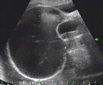 Майчин дом в 37 г.с. за определяне метода на родоразрешение предвид установен пренатално ехографски тумор в сакрококцигеалната област на плода, без субективни оплаквания от страна на бременността.