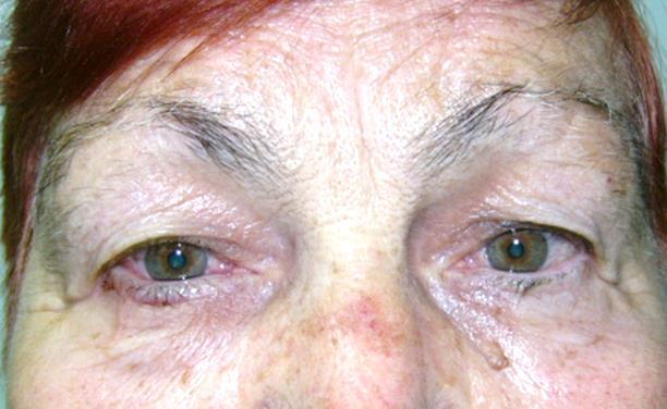 При петима пациенти от първата група са оперирани двете очи. Не са регистрирани интраоперативни усложнения и в двете групи болни.