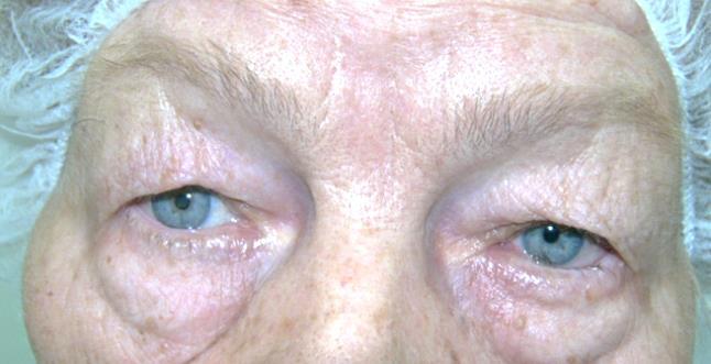 Инволутивен ентропион на ляво око- А, 1 месец